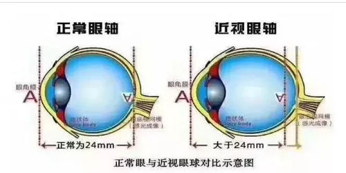早预防,不手术,这样可以轻松恢复视力