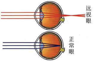 远视性弱视与近视性弱视的区别及防治重点